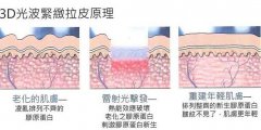 光波拉皮有哪些优势?为何那么受欢迎? width=