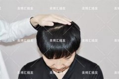 fut植发技术厉害吗？来看看这则案例！ width=