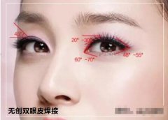 上海生物焊接双眼皮多少钱? width=