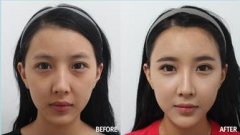 伊维兰隆下巴果是长久的吗? width=