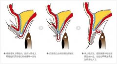 生物焊接双眼皮多少钱?想着周末去做~ width=