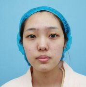 5S重睑术1-15天的恢复对比图：真人体验感受~ width=