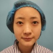 韩式翘睫双眼皮65天的恢复对比图：小姐妹的亲生体验~ width=