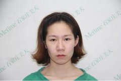 圣嘉新自体脂肪面部填充日记一则，你要不要看看~ width=