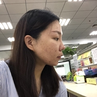 去颊脂垫有副作用吗?行家为了做较的解答
