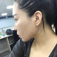 去颊脂垫有副作用吗?行家为了做较的解答