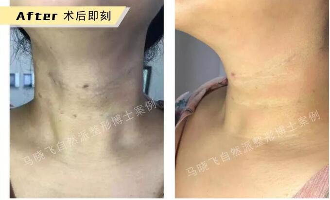 有颈纹怎么办？NBL细胞支架，帮你长久去除颈纹！