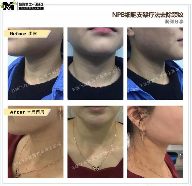 有颈纹怎么办？NBL细胞支架，帮你长久去除颈纹！