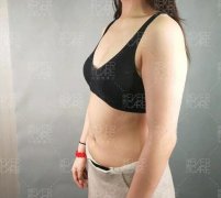 伊美尔4s多维立体吸脂瘦手臂两个月恢复记录分享~ width=