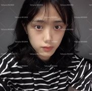 汕头曙光整形医院双眼皮案例，见证小姐姐的蜕变~ width=