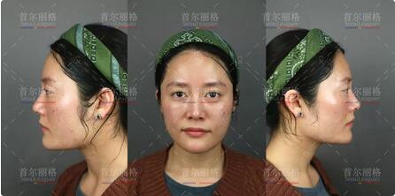 唇腭裂整形后的她，成为美到打破次元壁的女生！