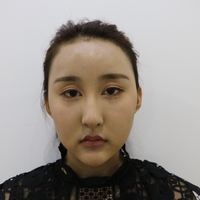 蒙古褶眼睛是什么样?果图及案例分享