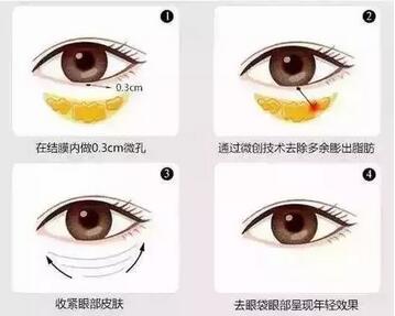 内吸去眼袋真实日记分享，还有前后对比果图片~