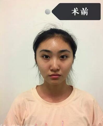 内吸去眼袋真实日记分享，还有前后对比果图片~
