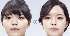 颧骨内推多少钱?哪些因素影响价格? width=