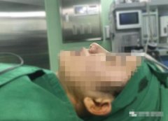 耳软骨垫鼻尖/鼻修复手术纪实——profile郑在皓院长 width=