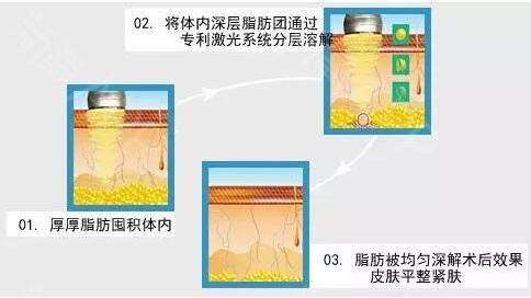 意大利plasma等离子激光光纤溶脂是怎么肥四?