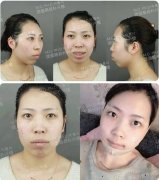 韩国双鄂手术真实经历全纪录，珍贵的资料~ width=