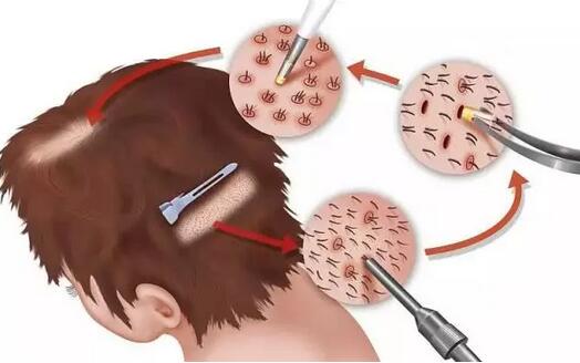 微创植发技术真的能让中国2亿的脱发人群脱离苦海吗？