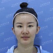 磨颧骨前后对比图，变化是不是很惊人 width=