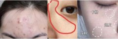 卡尼尔男士多抗痘洁面乳去闭口美白果是ZEI样滴~ width=