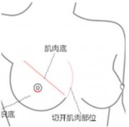 内窥镜德国vizaar威萨取奥美定全程详细记录，果很不错~ width=