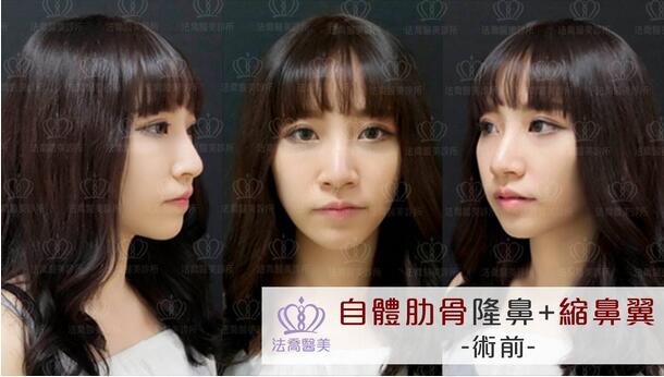 大连王艇隆鼻案例大方分享，你不要吝啬来看看哦！