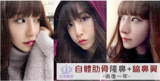 大连王艇隆鼻案例大方分享，你不要吝啬来看看哦！