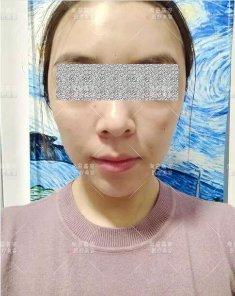 王绍国讲述给患者做多方面部脂肪填充来龙去脉~