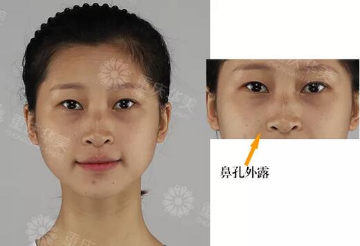 水滴鼻养成记|插座鼻变小俏鼻，女格斗教练整成“李沁”？