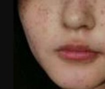 王苏波激光祛斑前后对比：102天经历三次皮肤光滑水嫩~ width=