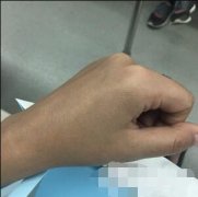 北京美白价格：美白变白对比图 width=