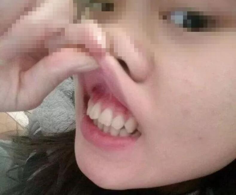 侯振杰外科正牙靠谱吗？侯振杰正牙案例图~