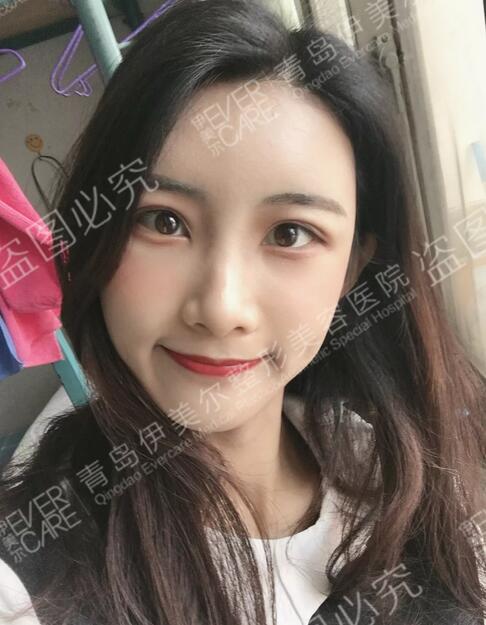 青岛伊美尔整形刘长发心形脸自体脂肪填充21天全记录~