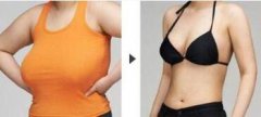 巨乳-缩小大概多少钱? width=