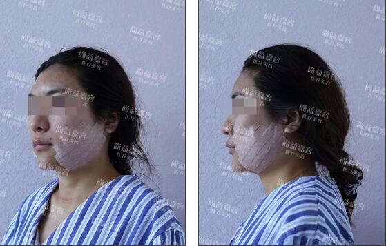 scarpa筋膜隆下颏+面部吸脂+面部脂肪填充真实记录，很详细哦~