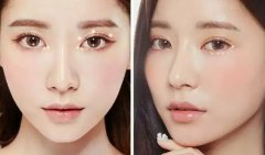 亚韩割双眼皮多少钱?贵不贵喃? width=