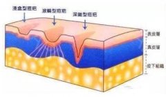 微针去痘坑多久见?能保持多久呢? width=