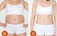 韩式共振吸脂减肥是啥?靠谱吗? width=