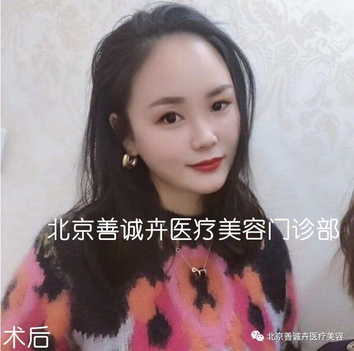 张维娜院长案例分享|SCH克隆骨隆鼻+下巴一起做，等于换一张脸？