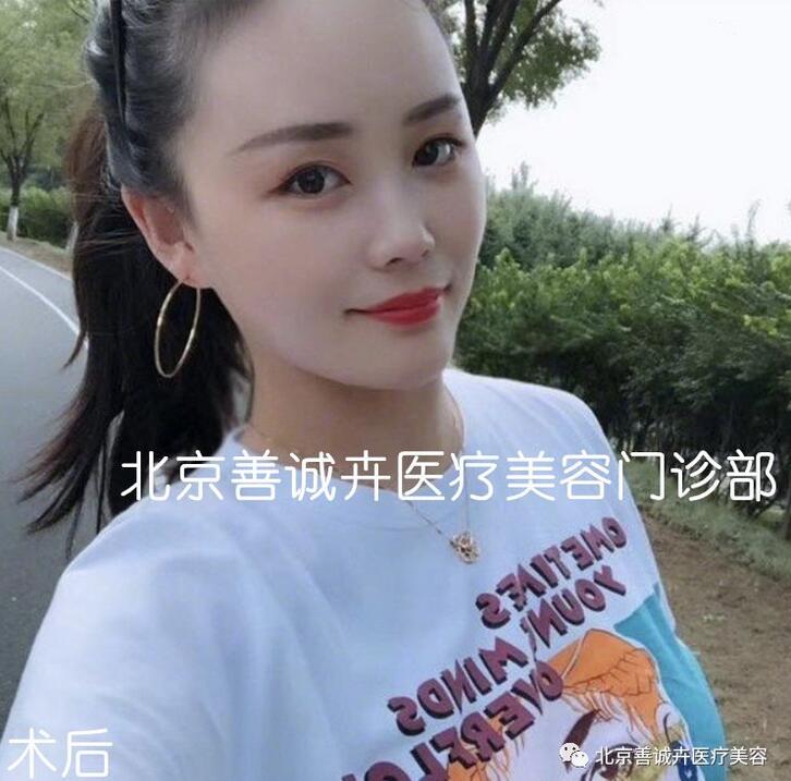 张维娜院长案例分享|SCH克隆骨隆鼻+下巴一起做，等于换一张脸？