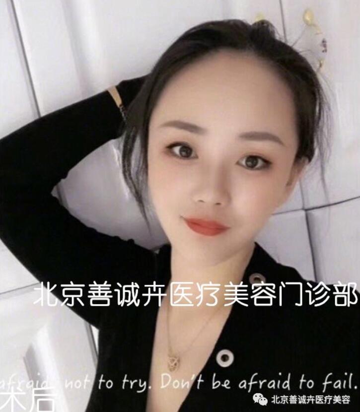 张维娜院长案例分享|SCH克隆骨隆鼻+下巴一起做，等于换一张脸？