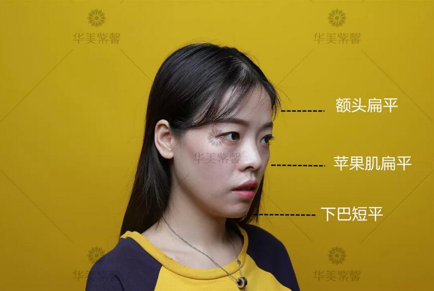 盘点了凹陷脸填充案例才发现，像王菲这样的脸绝不能这么填！！