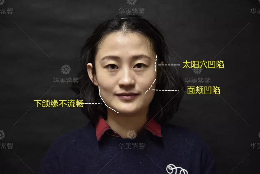 盘点了凹陷脸填充案例才发现，像王菲这样的脸绝不能这么填！！