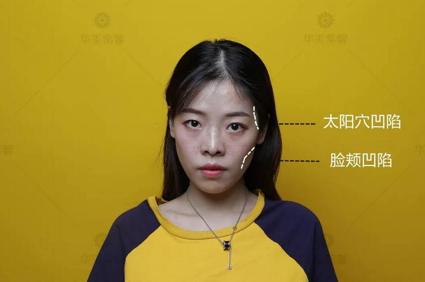盘点了凹陷脸填充案例才发现，像王菲这样的脸绝不能这么填！！