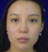天津维美整形医院隆鼻对比图分享：肉鼻不一定代表福气 width=