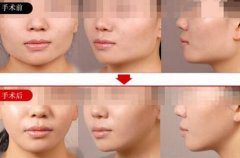 脸型整容价格一般多少? width=