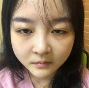 生物焊接双眼皮多少钱?我做一个生物焊接双眼皮一共1万9千8~ width=