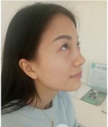 雅皙祛眼袋有吗？俺提着案例来告诉您！ width=