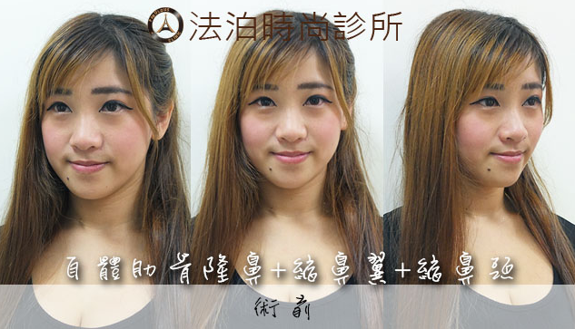 看娃娃做了自体肋软骨隆鼻+缩鼻翼，瞬间变得女神范儿了~
